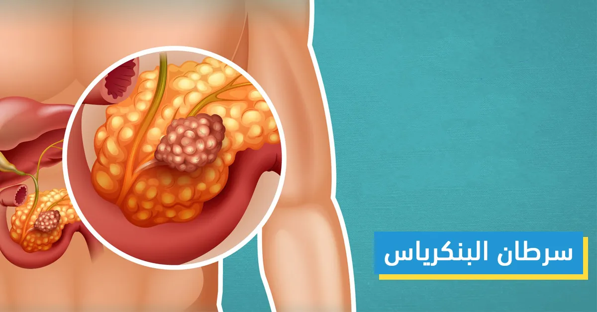 سرطان البنكرياس 